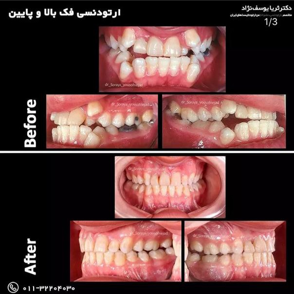لمینت دندان در بابل دکتر ثریا یوسف نژاد